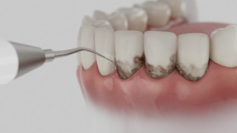 Trusted Teeth Cleaning And Checkup service in Pasadena Hills, MO - Dentist Open Now